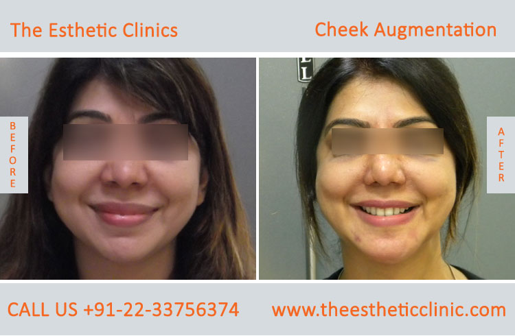 Cheek Augmentation, Cheek Implants surgery before after photos in mumbai india (8)